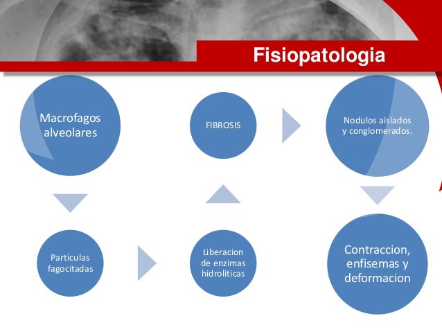 fisiopatologia de la silicosis